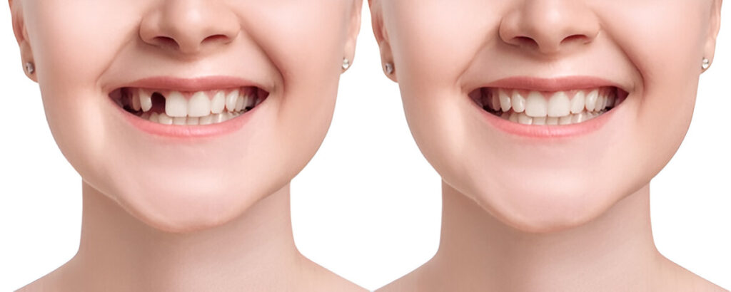 Dental Implants in Des Plaines