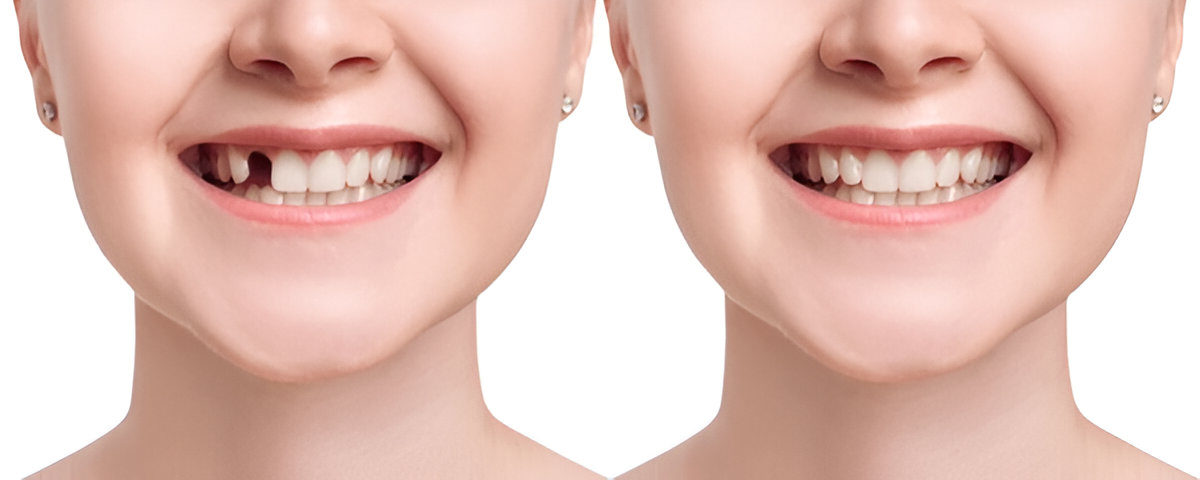 Before and after results of a woman’s smile restored with a single tooth implant at Bright Dental.
