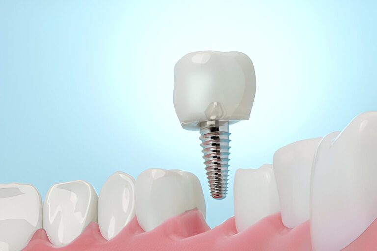 dental implants in des plaines