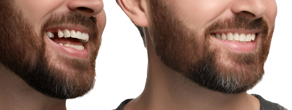 Single Dental Implant