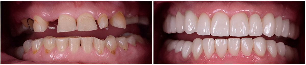 Before and after results of complete dental implants at Bright Dental, showing a confident new smile.