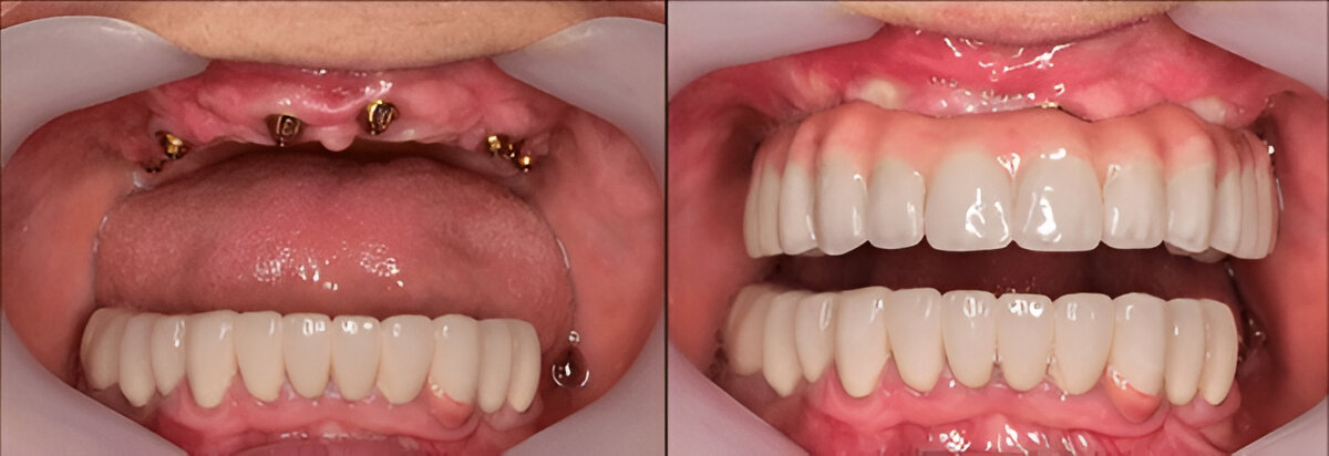 Before and after results of All-on-4 dental implants, showing a complete smile restoration at Bright Dental.