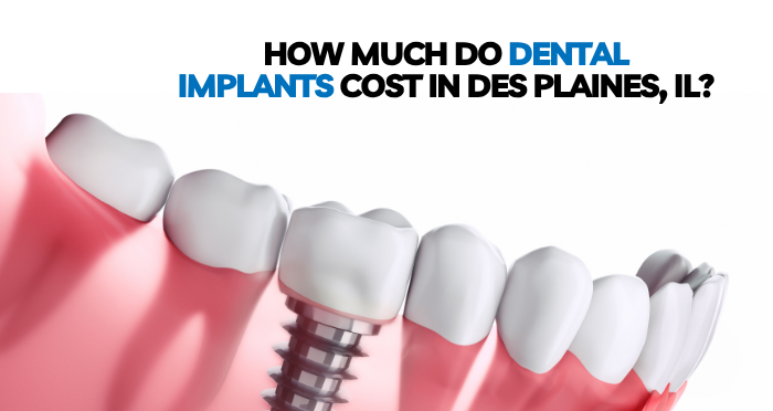 Dental Implants Cost In Des Plaines