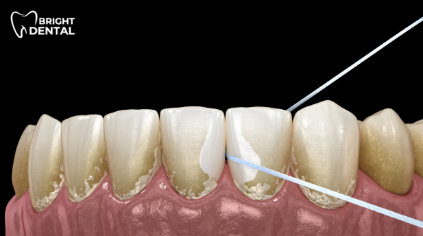 Dental floss being used to clean between teeth to support Tooth decay Prevention. 5 Essential Habits for Preventing Tooth Decay
