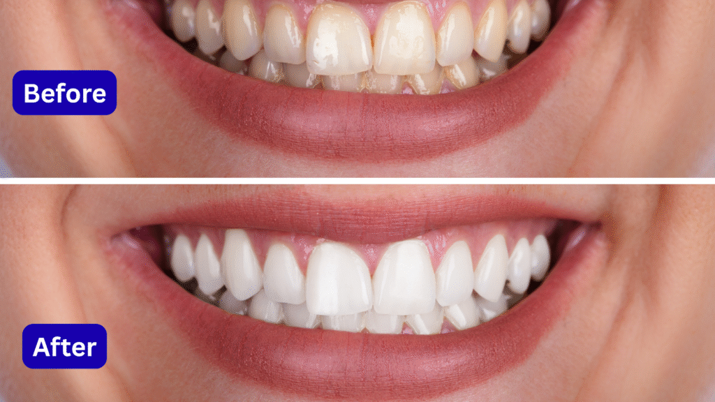 Before and after Invisalign results showing teeth alignment