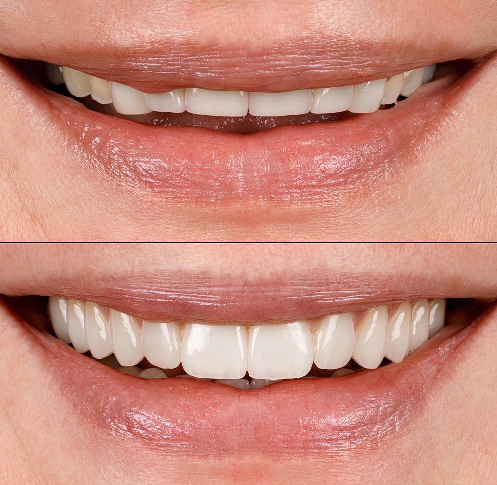 Smile Makeovers in Des Plaines