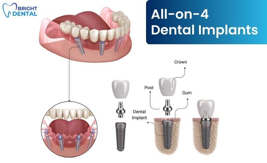 all on 4 dental implants