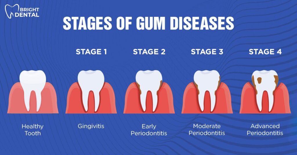 stages of gum diseases