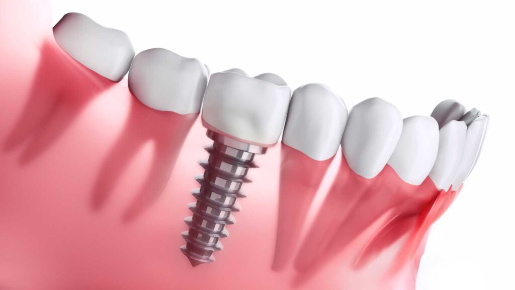 dental-implants-cost-in-des-plaines