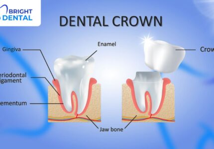Dental Crown in Des Plaines - Bright Dental in Des Plaines