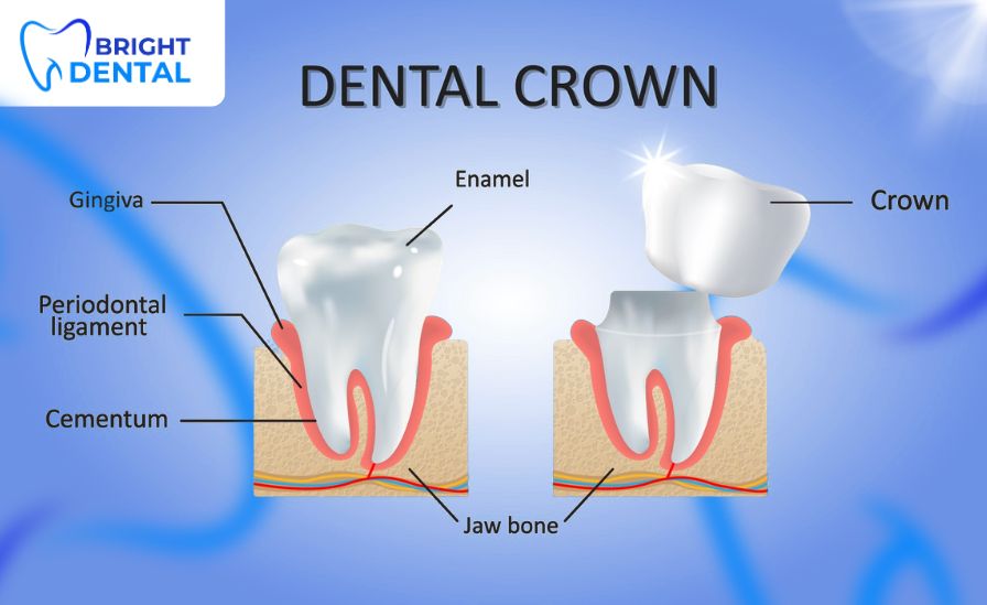 Dental Crown in Des Plaines - Bright Dental in Des Plaines