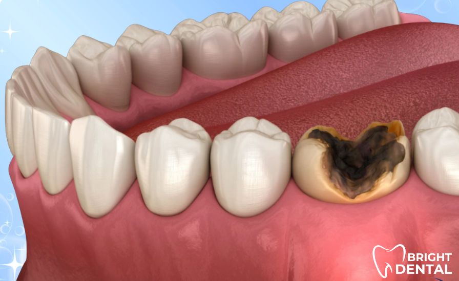 Patient experiencing severe tooth pain requiring root canal treatment in Des Plaines