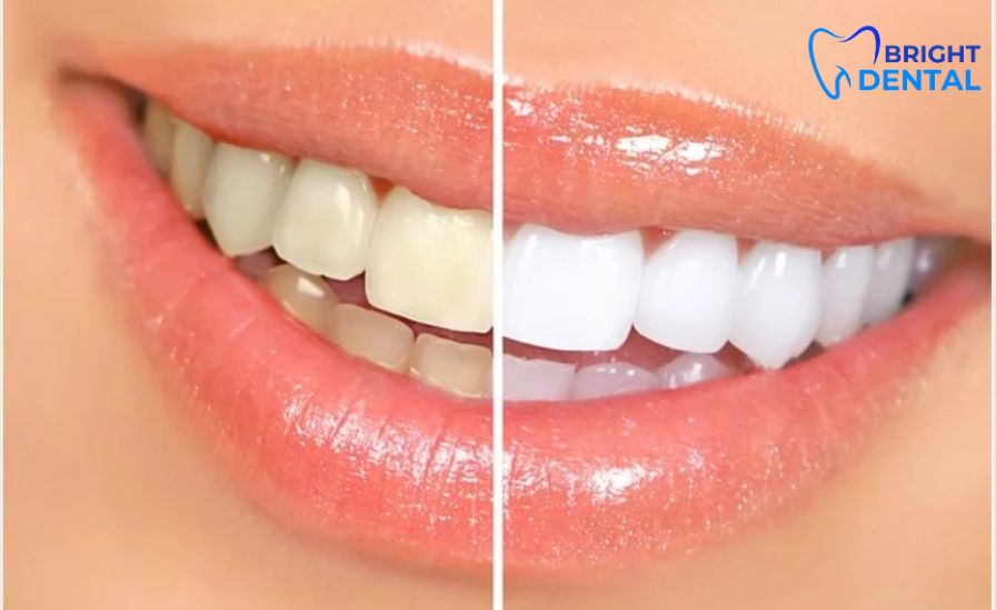 teeth whitening 