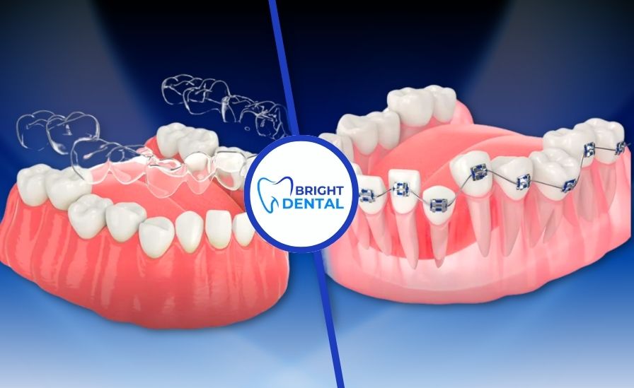 living with braces and Invisalign
