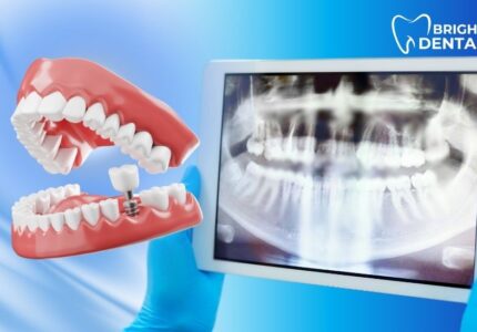 Digital Dental Implants Des Plaines