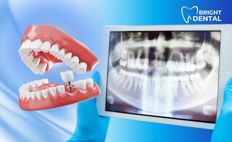 Digital Dental Implants Des Plaines