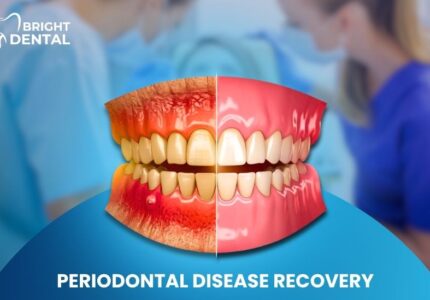 Periodontal Disease