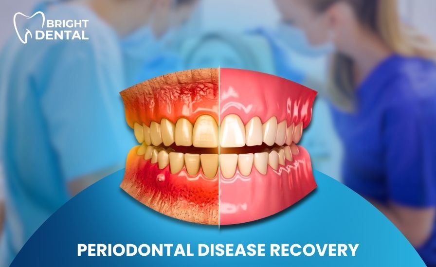 Periodontal Disease