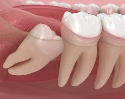 Wisdom Teeth Remove or Keep