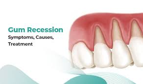 Gum Recession Causes & Treatment