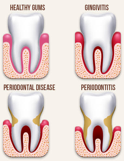 Gums Bleed When Brushing