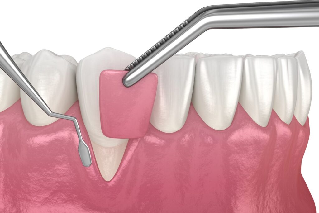 Gum Recession Causes & Treatment