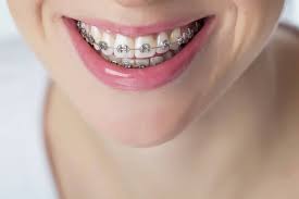 orthodontics for adults in des plaines