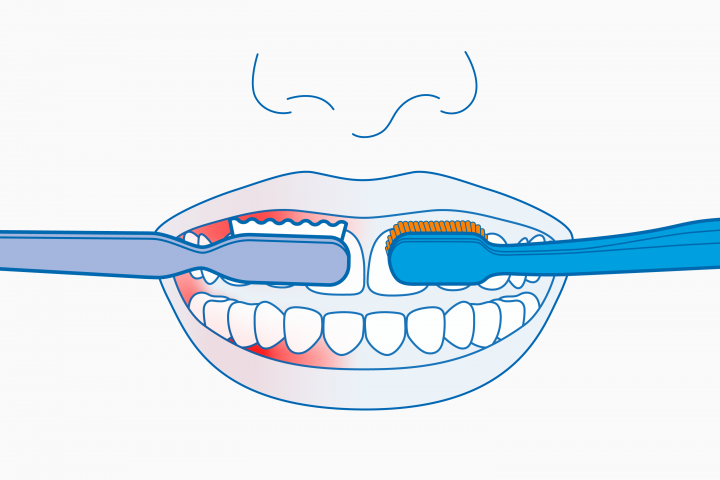 Gums Bleed When Brushing