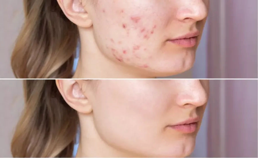 microneedling in des plaines