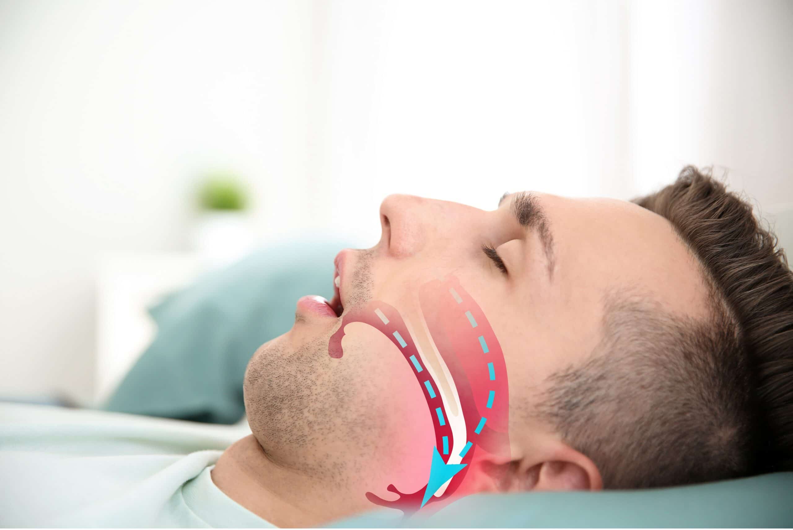 Sleep Apnea and Teeth