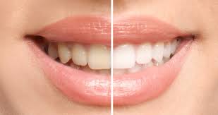 teeth whitening in des plaines