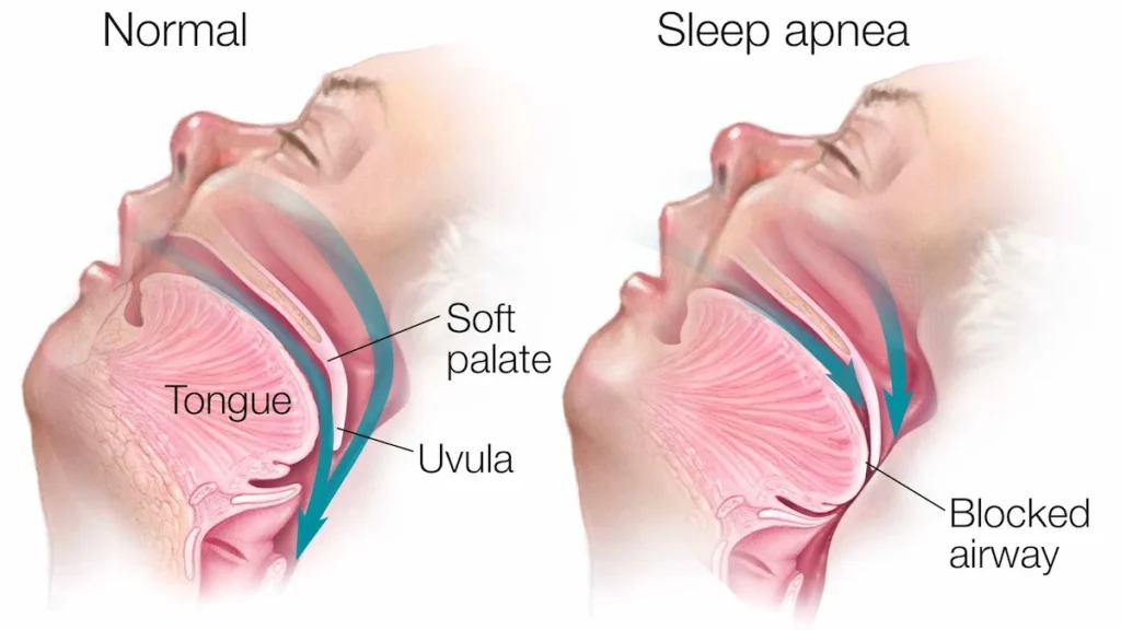 Sleep Apnea and Teeth