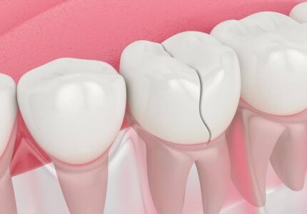 Broken or Chipped Tooth