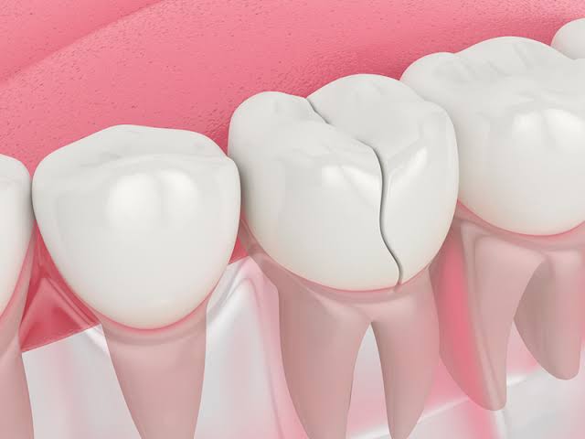 Broken or Chipped Tooth