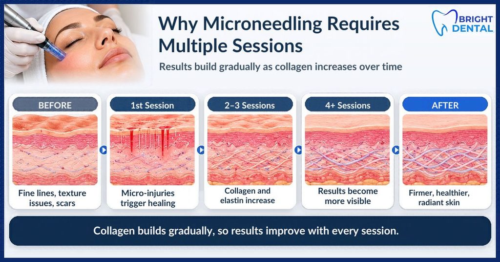 Illustration showing how multiple microneedling sessions stimulate collagen production, support skin healing, and gradually improve skin texture.