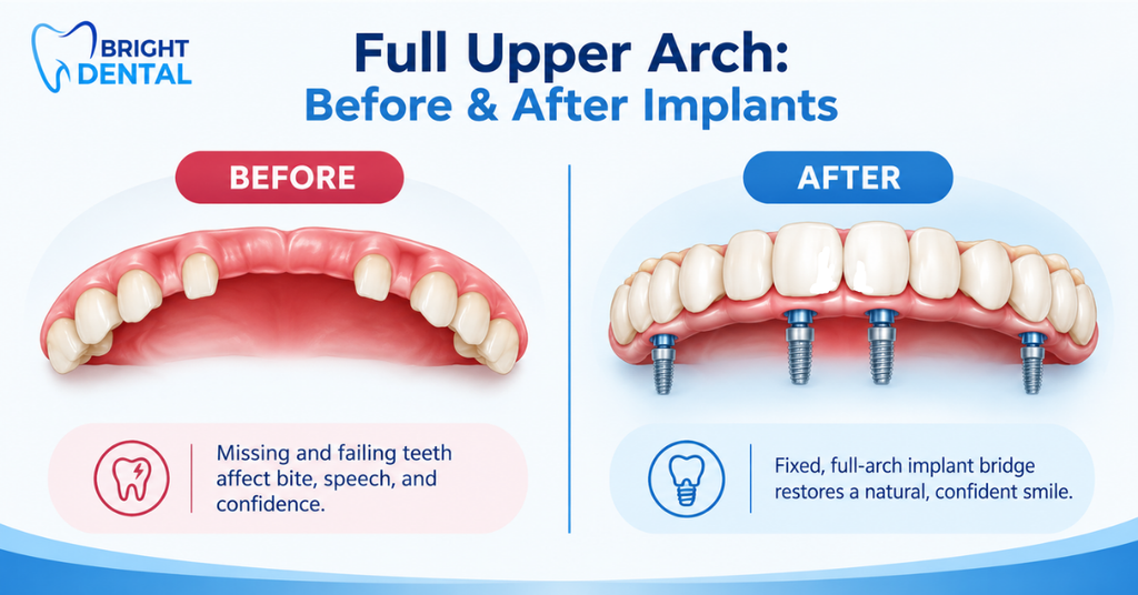 Before and after full upper arch dental implants showing missing teeth restored with a fixed bridge