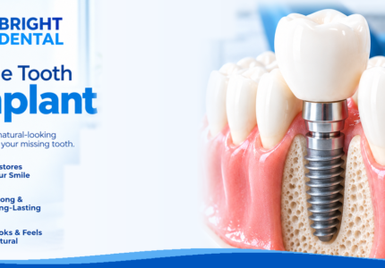 Single Tooth Implant: Procedure, Cost & Recovery Guide
