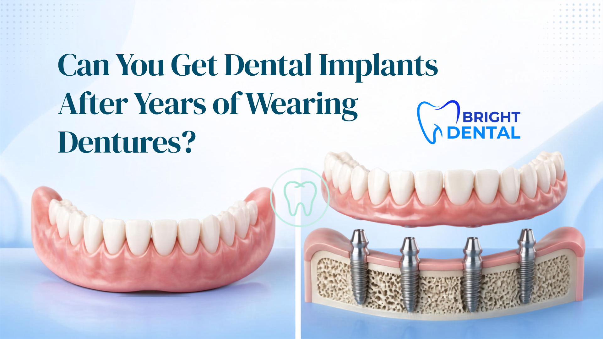Dentist evaluating jawbone density for dental implants after years of wearing dentures