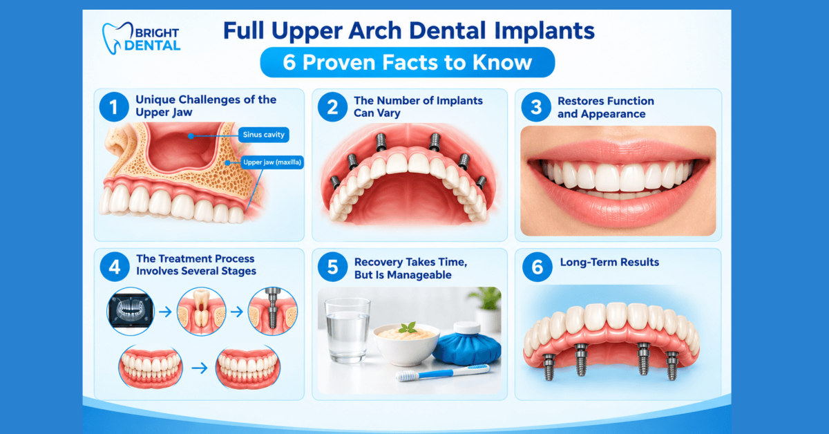 Infographic explaining six facts about full upper arch dental implants