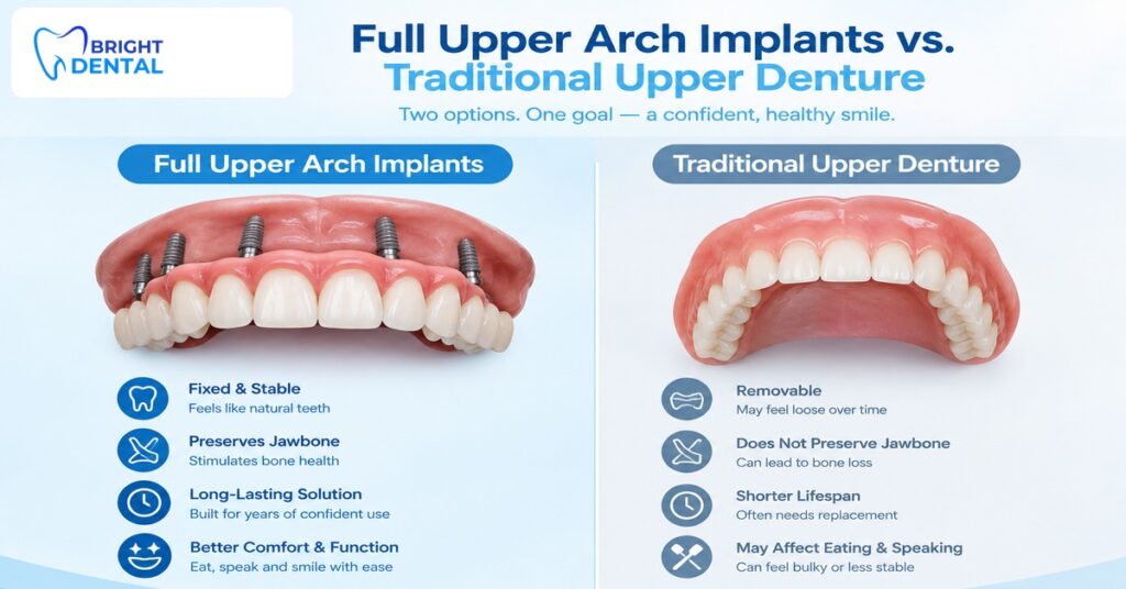 Comparison of full upper arch dental implants and traditional upper denture