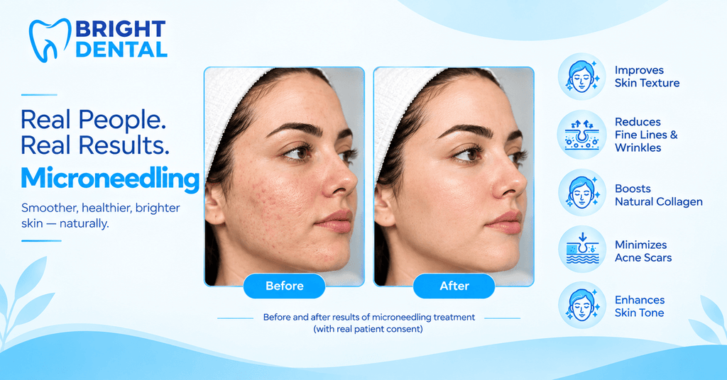 microneedling at bright dental clinic
