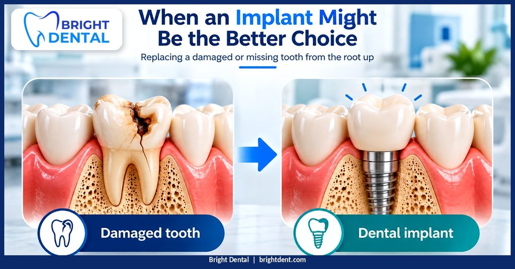 When an implant might be the better choice: damaged tooth compared with a dental implant and crown-dental implants vs. dental bridges