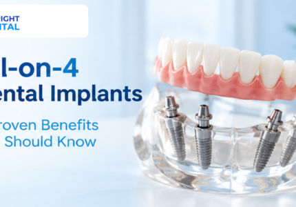 All-on-4 dental implants fixed bridge on model