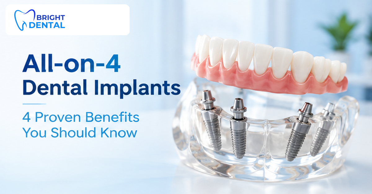 All-on-4 dental implants fixed bridge on model