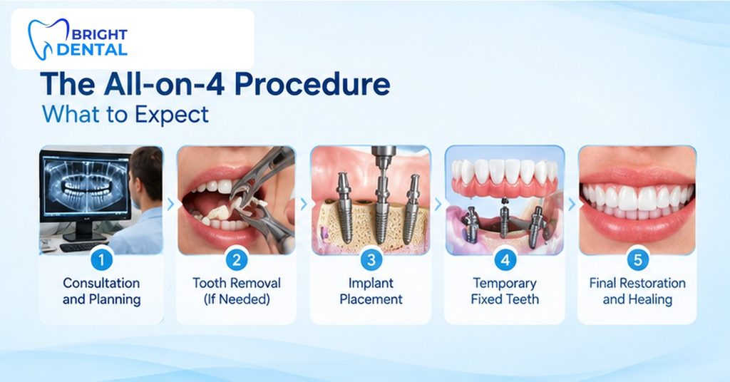 Step-by-step full-arch implant procedure at Bright Dental