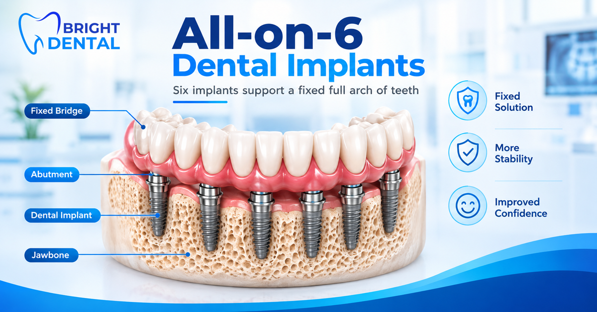 All-on-6 dental implants diagram showing six implants in the jawbone supporting a fixed full arch bridge, with labels for abutment, implant and jawbone