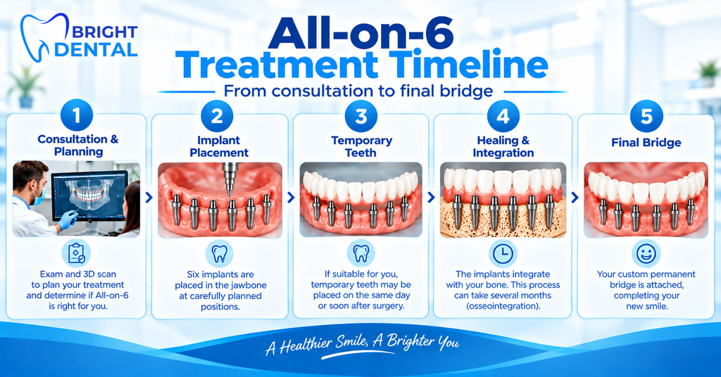Five-step All-on-6 treatment timeline: consultation and planning, implant placement, temporary teeth, healing and integration, and final bridge