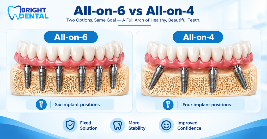Side-by-side comparison of All-on-6 with six implant positions and All-on-4 with four angled implant positions supporting a full arch of teeth