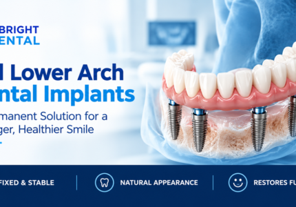 Full lower arch dental implants showing four implants supporting a fixed set of teeth in the jawbone