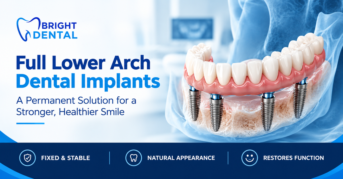 Full lower arch dental implants showing four implants supporting a fixed set of teeth in the jawbone